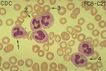 Leucocitos normales
Referencias:
1- neutrófilo en banda
2- neutrófilos segmentados
3- eritrocito
4- neutrófilo en segmentación
Aumento:
400 veces

Coloración:
May Grunwald - Giemsa